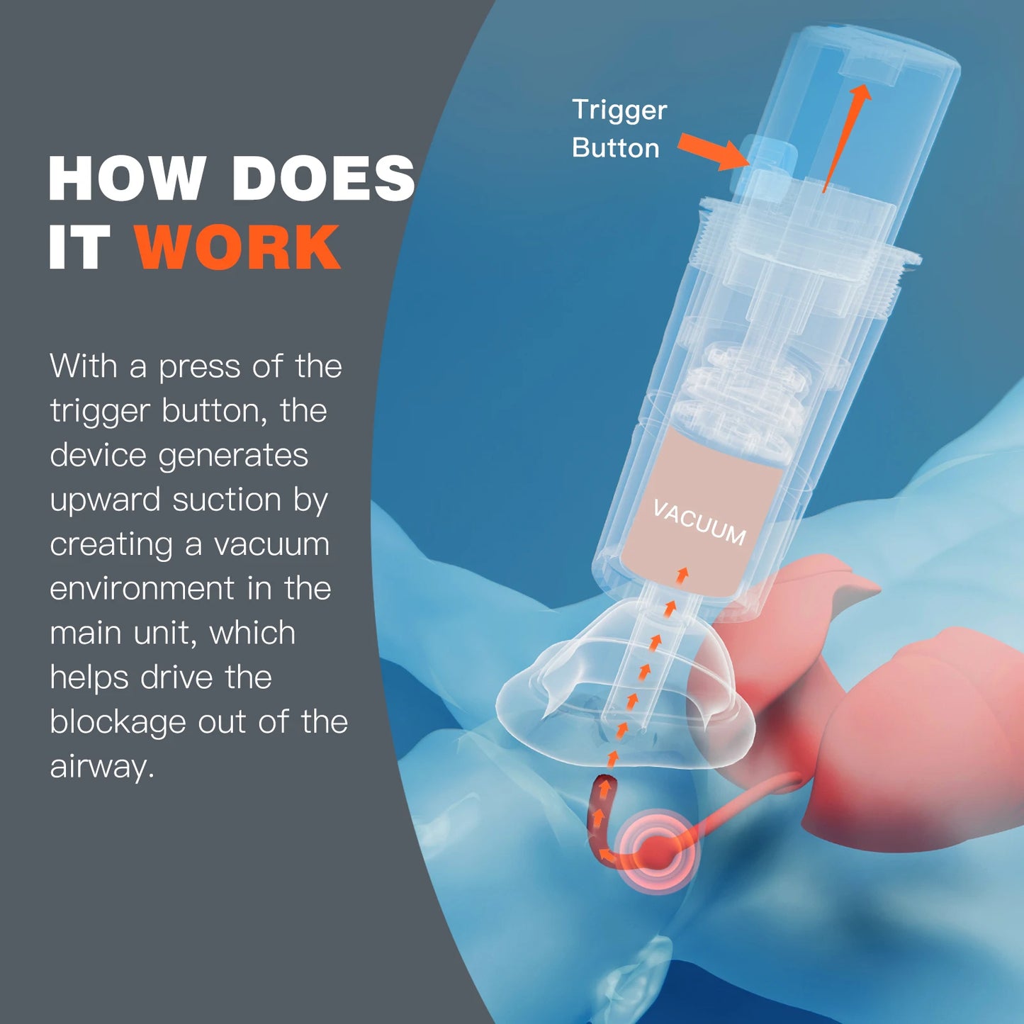 Sonmol Choking Rescue Device